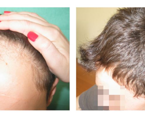 Haartransplantation Headdress Linz, Vorher Nachher Foto