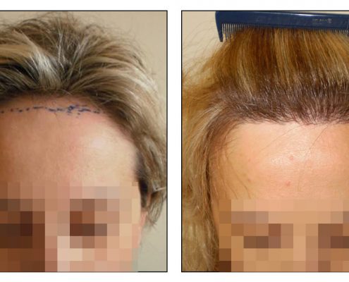 Haartransplantation Headdress Linz, Vorher Nachher Foto