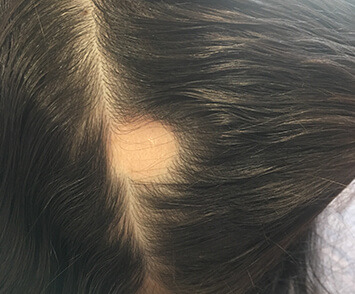 Haar Behandlung und Volumed Therapie bei Alopecie Termin 1