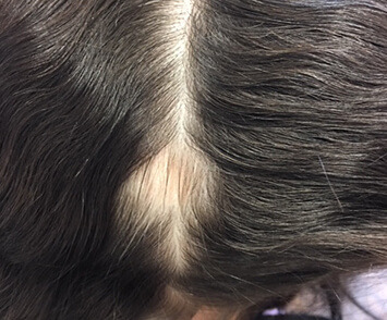 Haar-Behandlung und Volumed Therapie bei Alopecie Termin 2