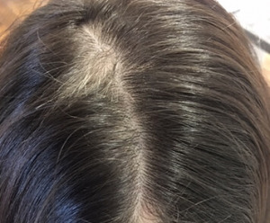 Haar Behandlung und Volumed Therapie bei Alopezie Termin 2