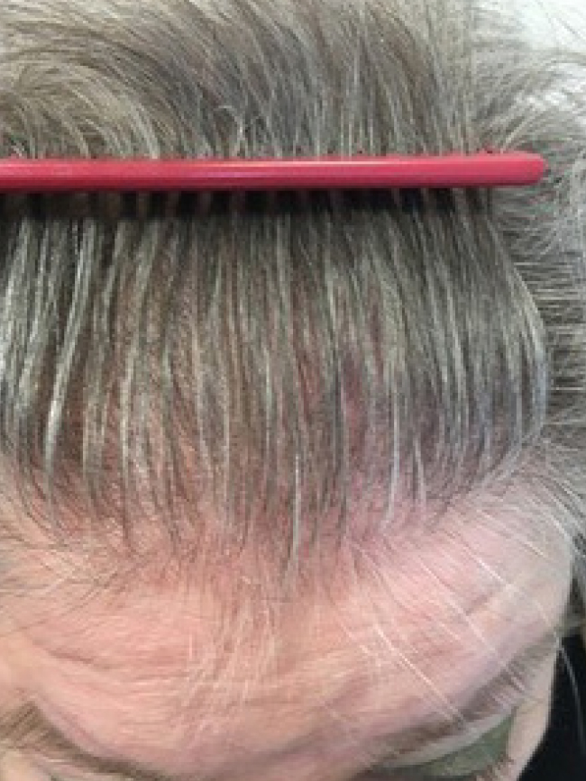 Haarausfall Vorher Nachher Alopezie Hilfe. Produkte gegen Haarausfall, kreisrunden Haarausfall, diffusen Haarausfall, Haarausfall Gegenmittel jetzt online bestellen.