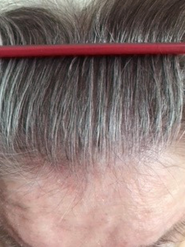 Haarausfall Vorher Nachher Alopezie Hilfe. Produkte gegen Haarausfall, kreisrunden Haarausfall, diffusen Haarausfall, Haarausfall Gegenmittel jetzt online bestellen.
