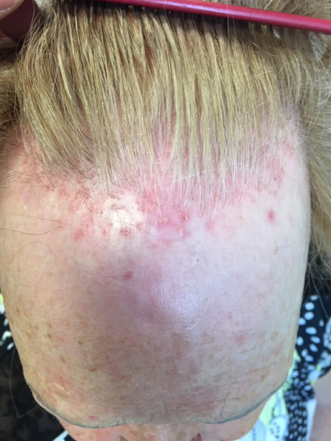 Vernarbte Alopezie Vorher Nachher Bilder. Produkte gegen Haarausfall, kreisrunden Haarausfall, diffusen Haarausfall, Haarausfall Gegenmittel jetzt online bestellen.