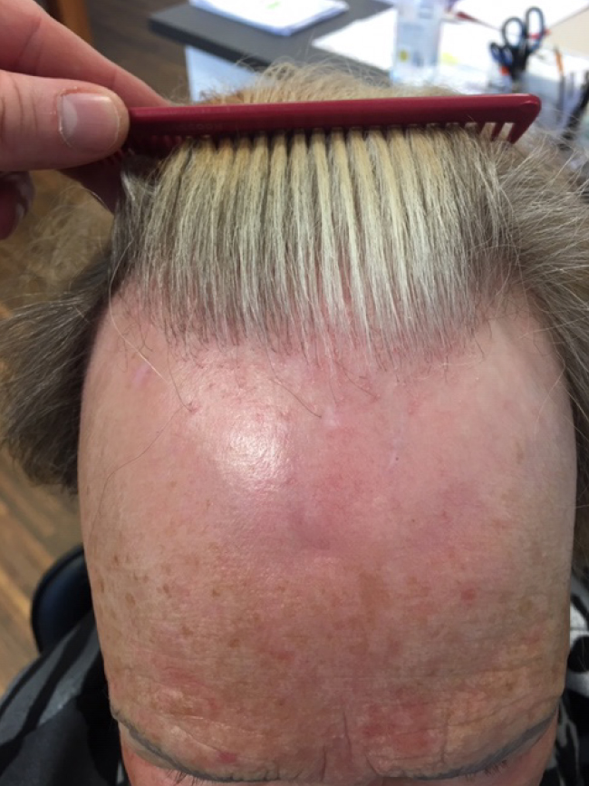 Vernarbte Alopezie Vorher Nachher Bilder. Produkte gegen Haarausfall, kreisrunden Haarausfall, diffusen Haarausfall, Haarausfall Gegenmittel jetzt online bestellen.