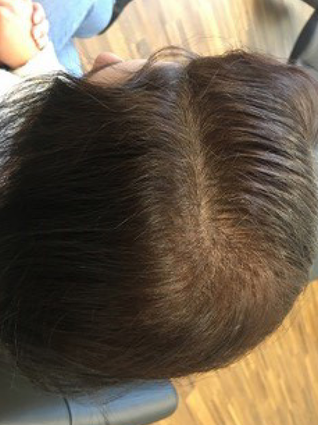 Vorher Nachher Bilder hormoneller Haarausfall. Produkte gegen Haarausfall, kreisrunden Haarausfall, diffusen Haarausfall, Haarausfall Gegenmittel jetzt online bestellen.