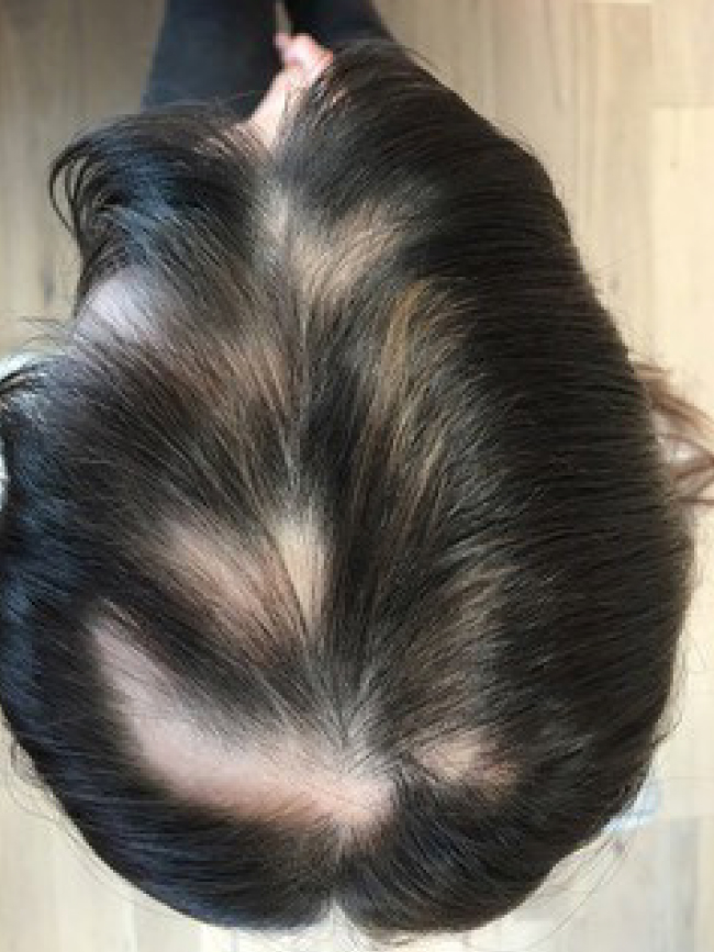 Welche Salbe bei kreisrundem Haarausfall?