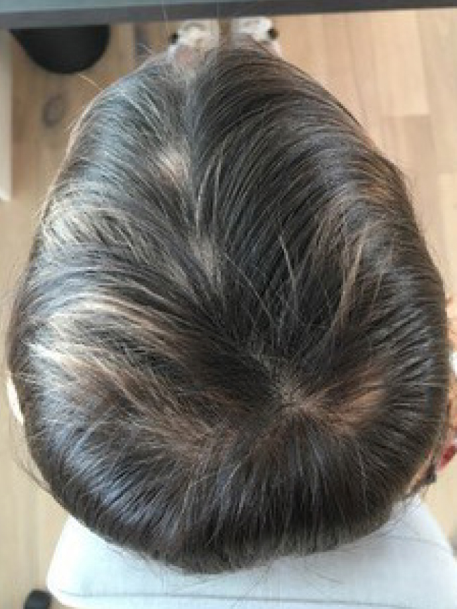 Alopezie Vorher Nachher Bild Behandlung. mittel gegen Haarausfall, Alopezie, kreisrundem Haarausfall